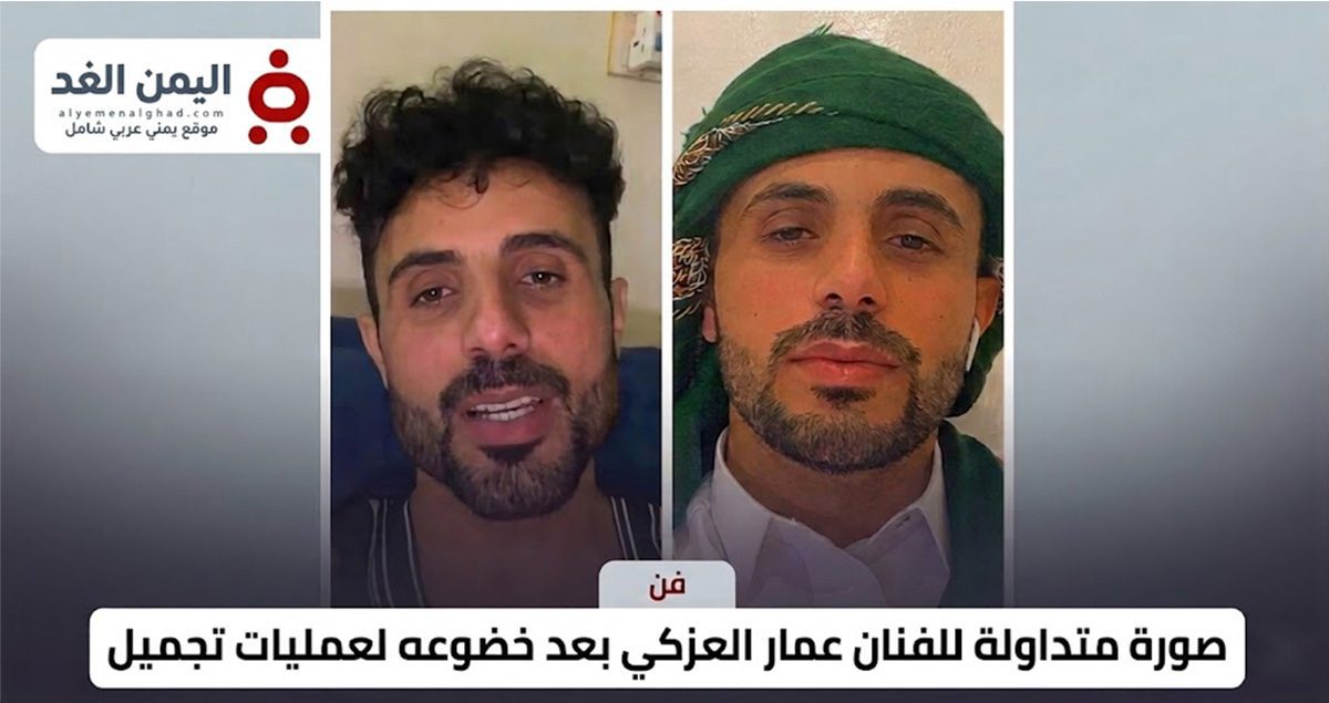 صدمة وتفاعل واسع.. ملامح جديدة للفنان عمار العزكي بعد خضوعه لعملية تجميل (صورة)