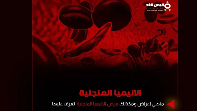 الانيميا المنجلية فقر الدم المنجلي ماهو اسباب اعراض علاج مضاعفات anemia 1 الانيميا المنجلية