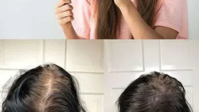 0969400d86d2f1c95806e87142d10747 jpg | علاج تساقط الشعر 2025 افضل علاج تساقط الشعر للرجال النساء وصفات