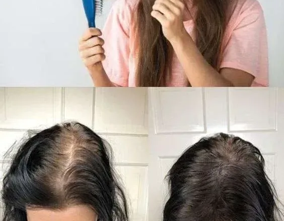 0969400d86d2f1c95806e87142d10747 jpg | علاج تساقط الشعر 2025 افضل علاج تساقط الشعر للرجال النساء وصفات