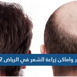 1641792070 اسعار واماكن زراعة الشعر في الرياض 2022