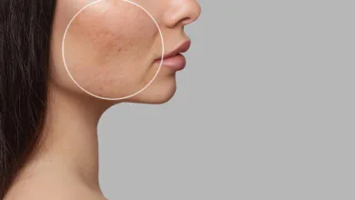 حفر الوجه و آثار الحبوب فيه و طرق التخلص منها