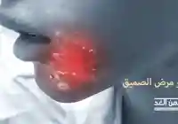 ماهو مرض أبو الصميق