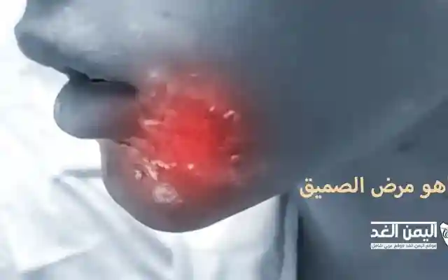 ماهو مرض الصميق وماهي أسباب مرض ابو الصميق وأعراضه وعلاجه