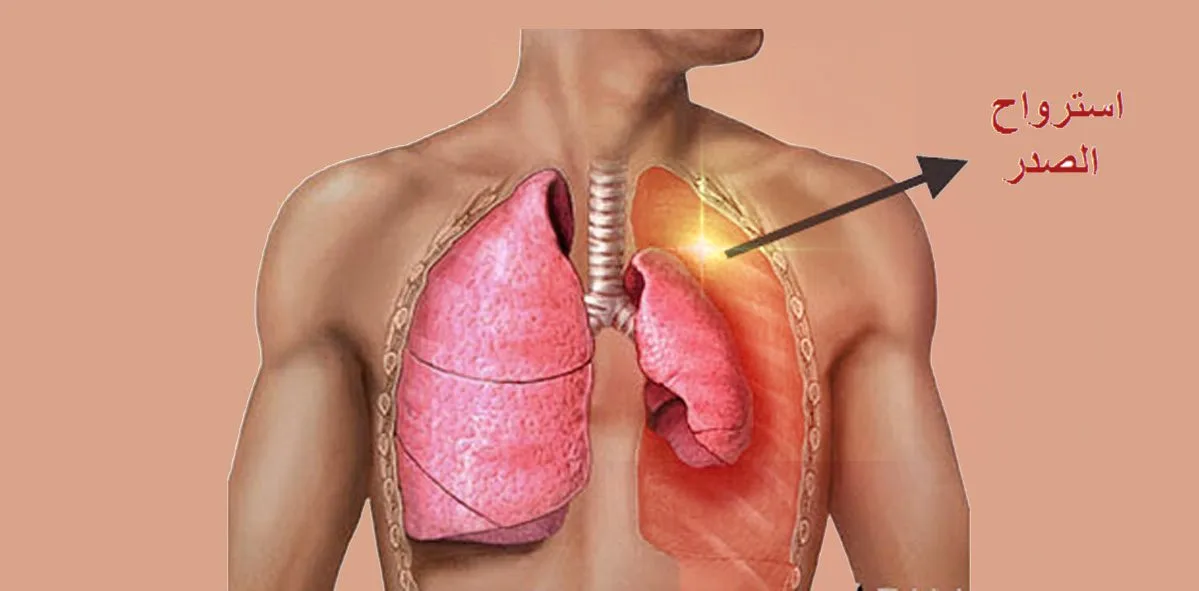 ماهو إسترواح الصدر الأعراض الأسباب وطرق العلاج Pneumothorax ماهو إسترواح الصدر الأعراض الأسباب وطرق العلاج Pneumothorax