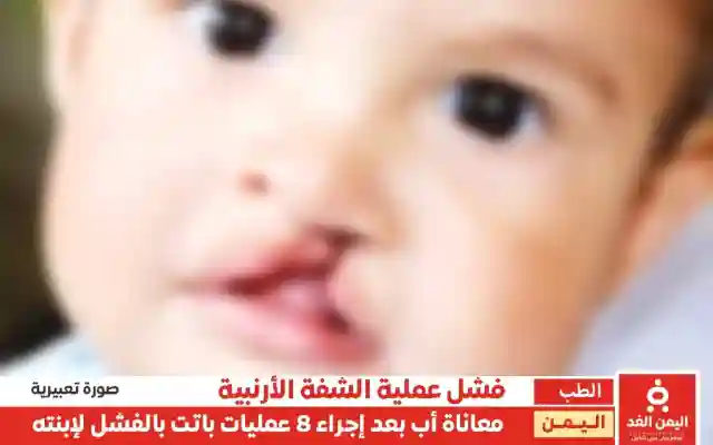 معاناة مواطن في عدن بسبب الفشل الطبي وإجراء 8 عمليات فاشلة لإبنته “الشفة الأرنبية”